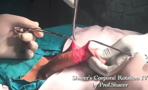 1- Shaeer's Corporal Rotation - Skin incision