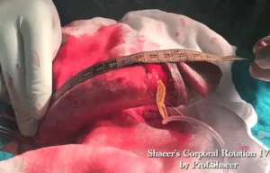 3- Shaeer's Corporal Rotation - Artificial erection