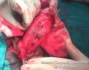 4- Shaeer’s Corporal Rotation - Mobilization of the neurovascular bundle