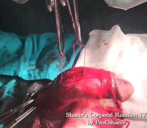5- Shaeer’s Corporal Rotation - Rotation of the corpora cavernosa - Placing the rotation sutures
