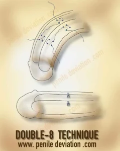 Double eight technique for correction of penile curvature