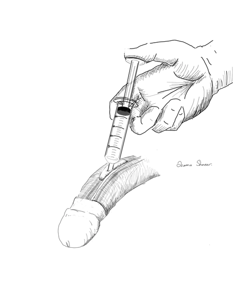 Hydro-dissection of the NeuroVascular Bundle