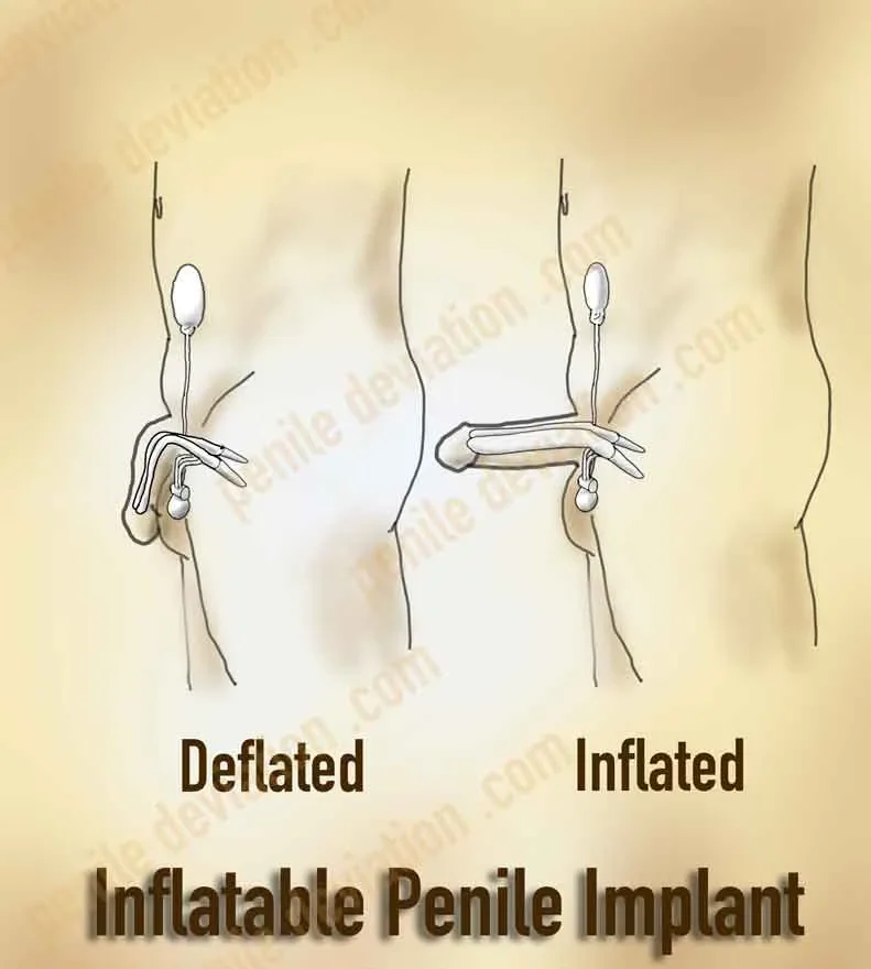Inflatable penile implant | Coloplast Titan | Rigicon Infla10 Pulse | Boston Scientific AMS 700