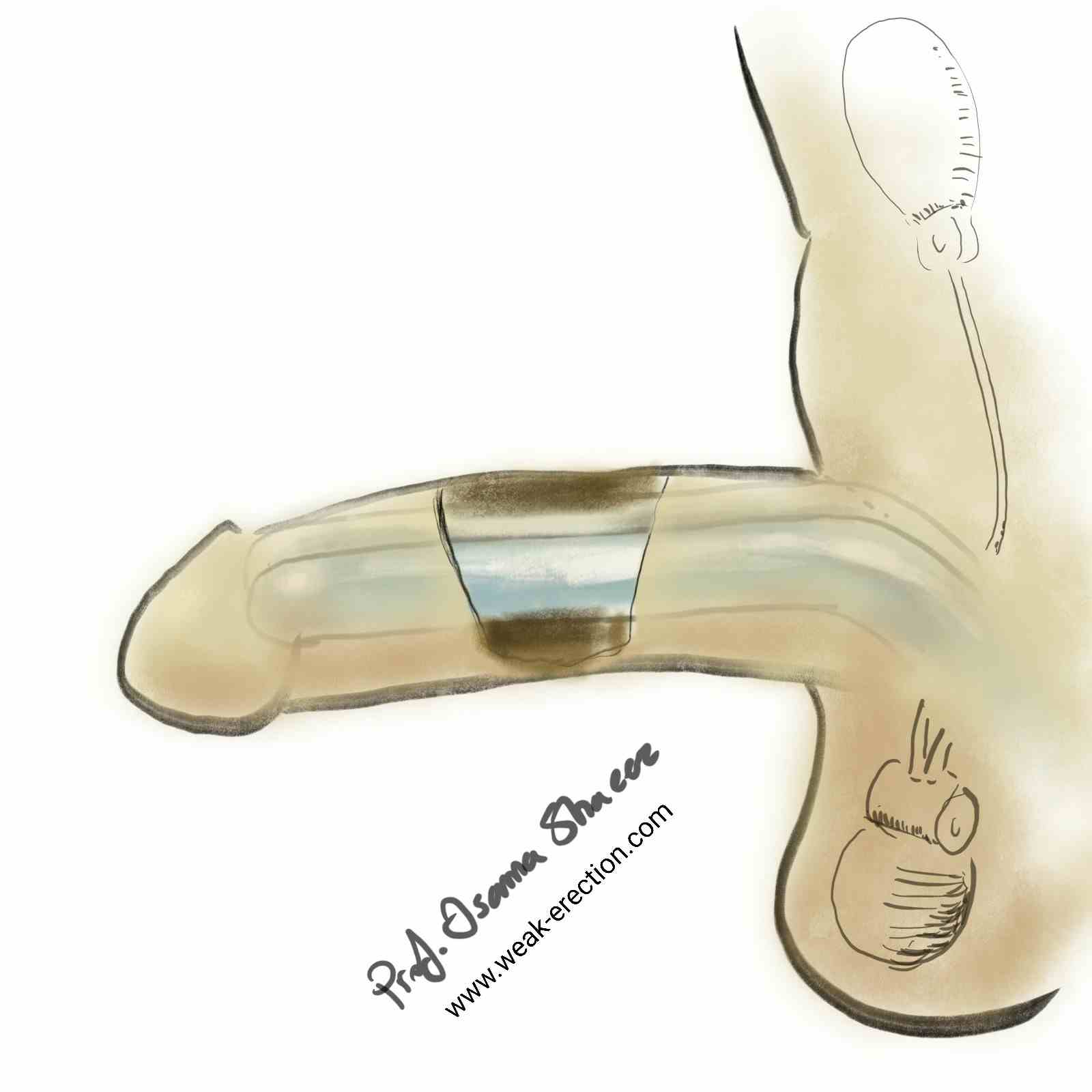 Inflatable Penile Implant - Image 4