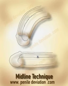 Midline technique for correction of penile curvature