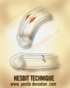 Nesbit technique for correction of penile curvature