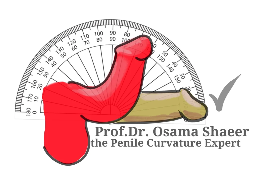Congenital penile curvature or chordee is a congenital abnormality where one aspect of the penis overgrows the other, leading to the penis bending towards the shorter side upon erection
