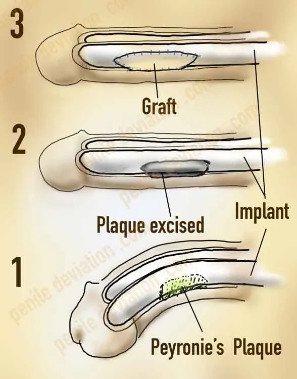 Peyronie's Plaque Excision and Grafting
