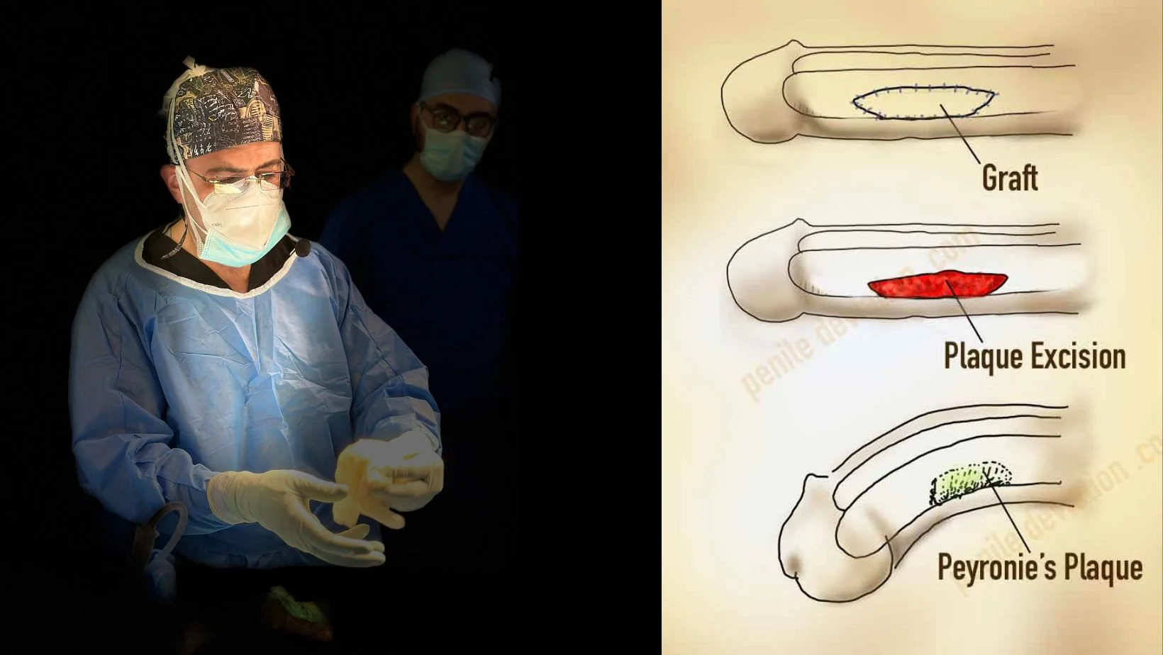 Peyronie’s Disease