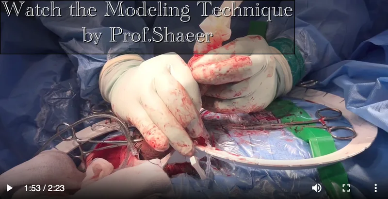 Peyronie's Modeling Technique with penile implant surgery