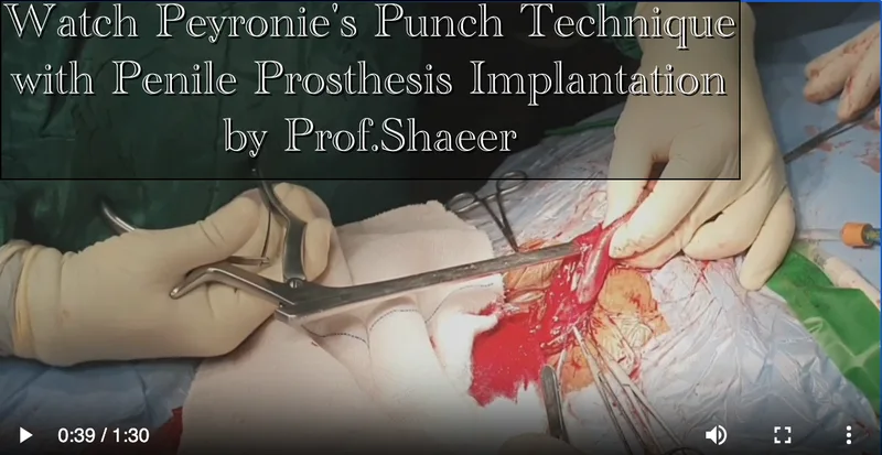 Watch Peyronie's Punch Technique with Penile Prosthesis Implantation