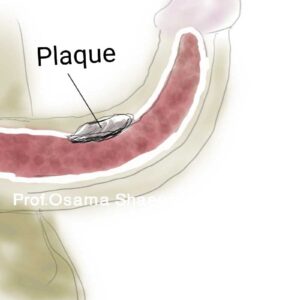 Peyronie's plaque surgery