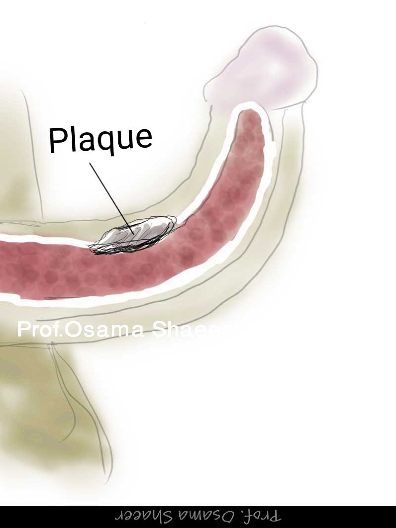 Peyronie's plaque surgery