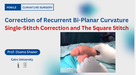 Shaeer's Square knot for penile curvature correction.webp