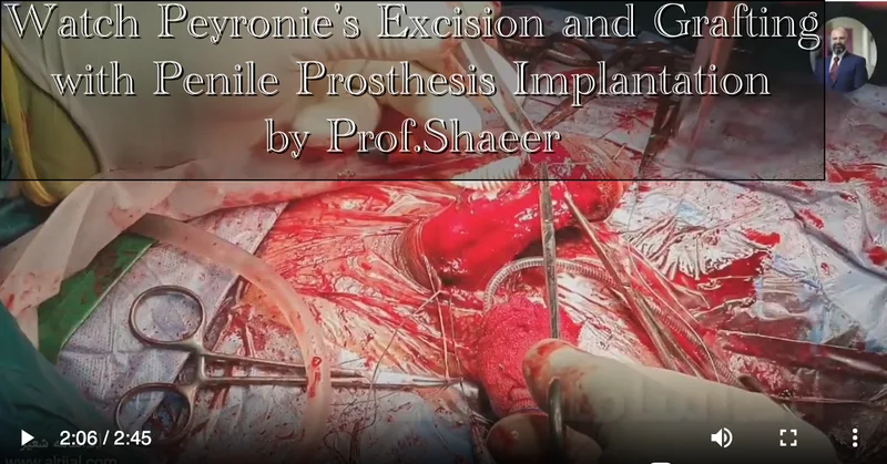 Watch Peyronie's Excision and Grafting with Penile Prosthesis Implantation