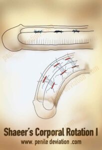 Shaeer’s Corporal Rotation-I 