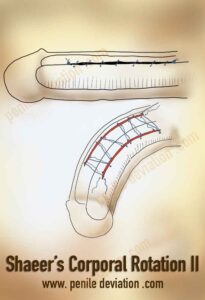 Shaeer’s Corporal Rotation II : No-shortening correction of penile curvature