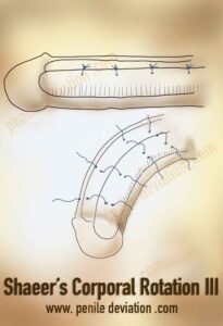 Shaeer’s Corporal Rotation III : No-shortening correction of penile curvature