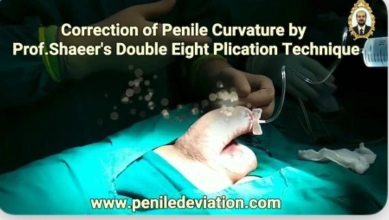 Shaeer's Double eight technique for correction of penile curvature.webp