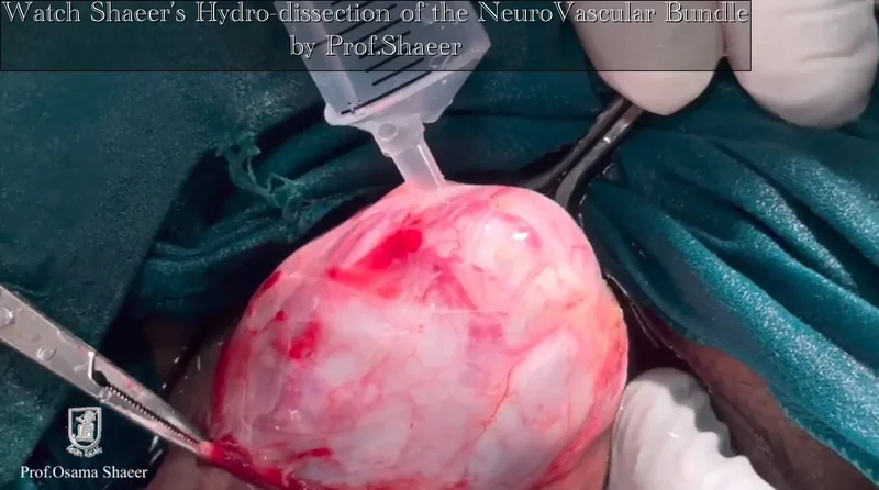 Shaeer’s Hydro-dissection of the NeuroVascular Bundle