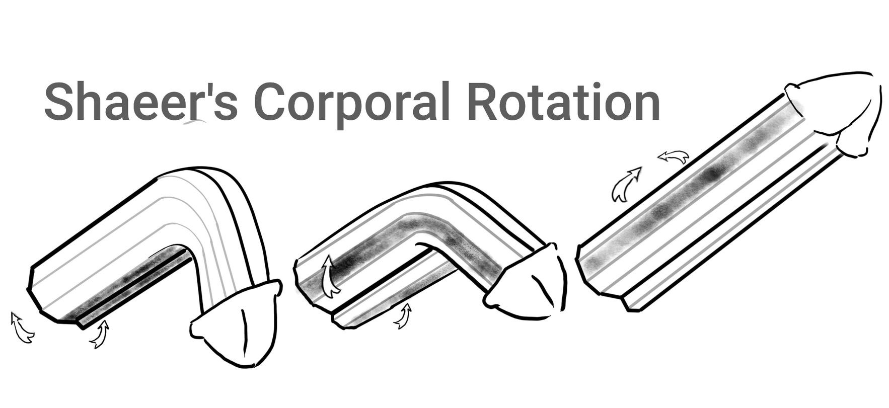 Shaeer's Corporal Rotation corrects severe ventral penile curvature with minimal shortening