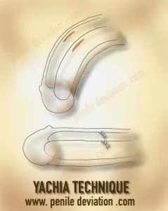 Yachia technique for correction of penile curvature