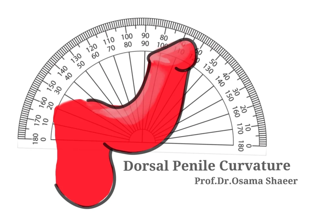Dorsal Penile Curvature is when the penis bends upwards when erect