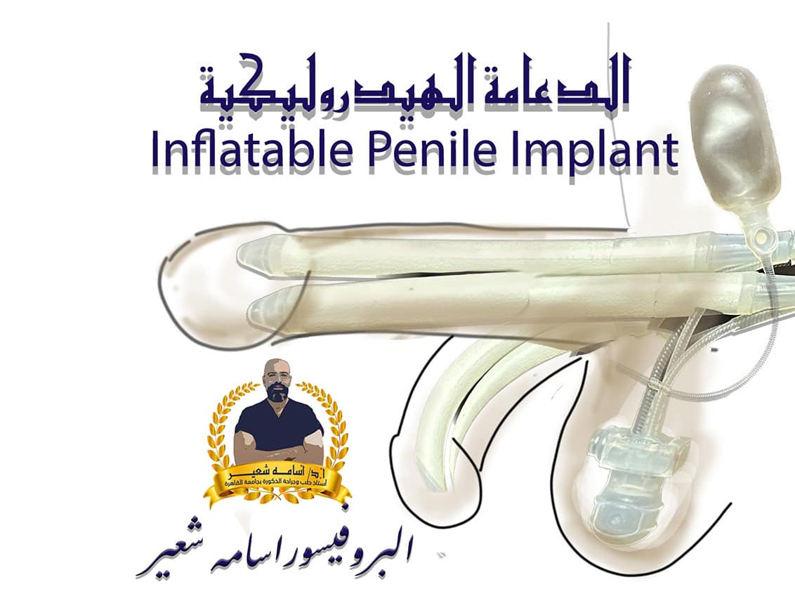 Inflatable Penile Implant
