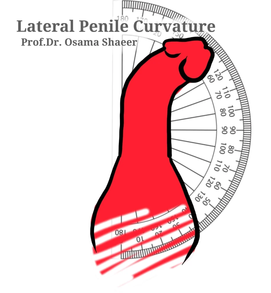 Lateral penile curvature is when the erect penis bends sideways to the right or left