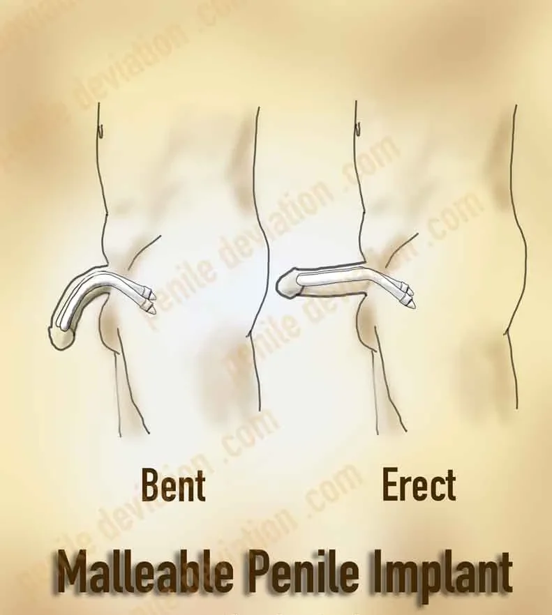 Malleable penile implant | Coloplast Genesis | Rigicon Rigi10 | Boston Scientific Tactra