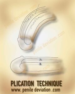 plication technique for correction of penile curvature