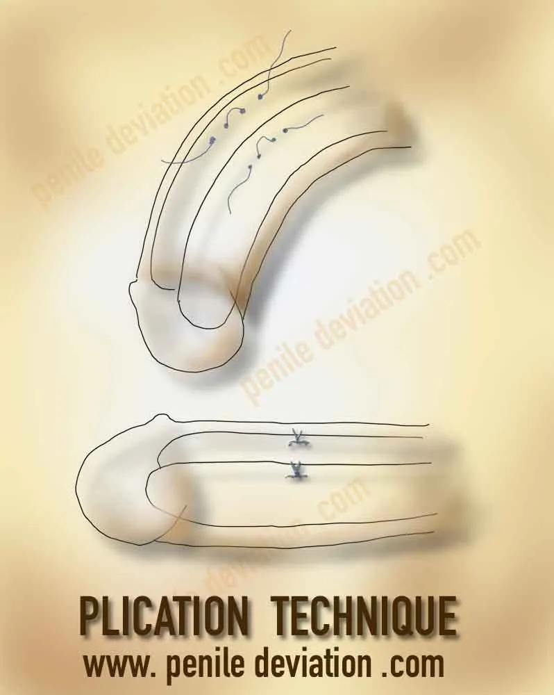 Penile Curvature Shortening Techniques