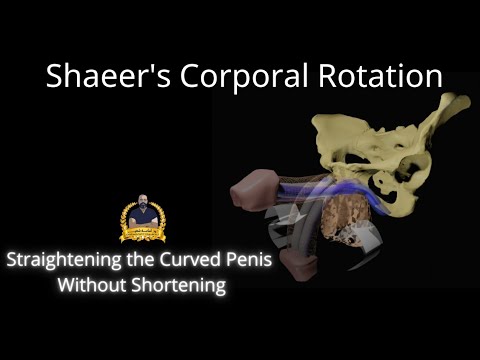 Corporal Rotation III for correction of penile curvature without shortening