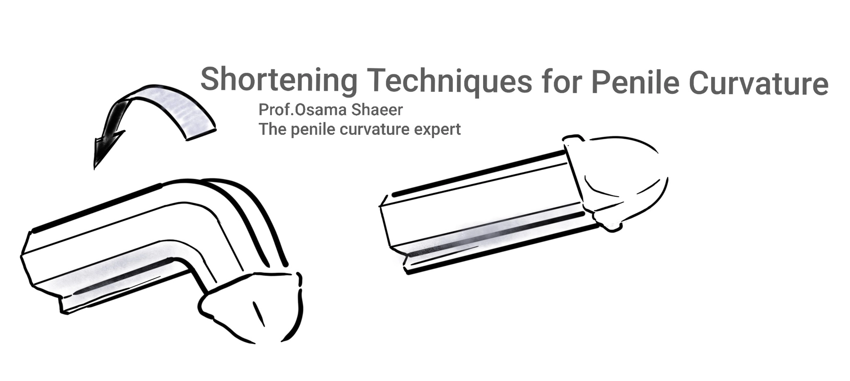 Shortening techniques for correction of penile curvature are centered upon shortening the longer convex side of the corpora cavernosa to match the shorter concave side.