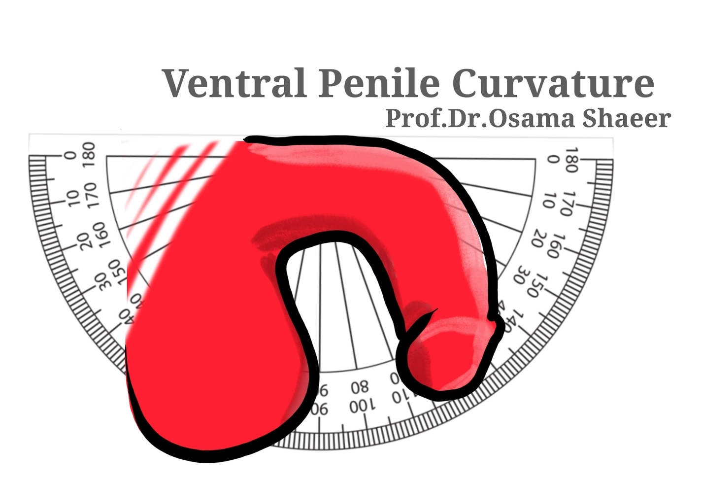 Ventral penile curvature
