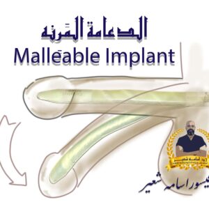 Malleable Penile Implant