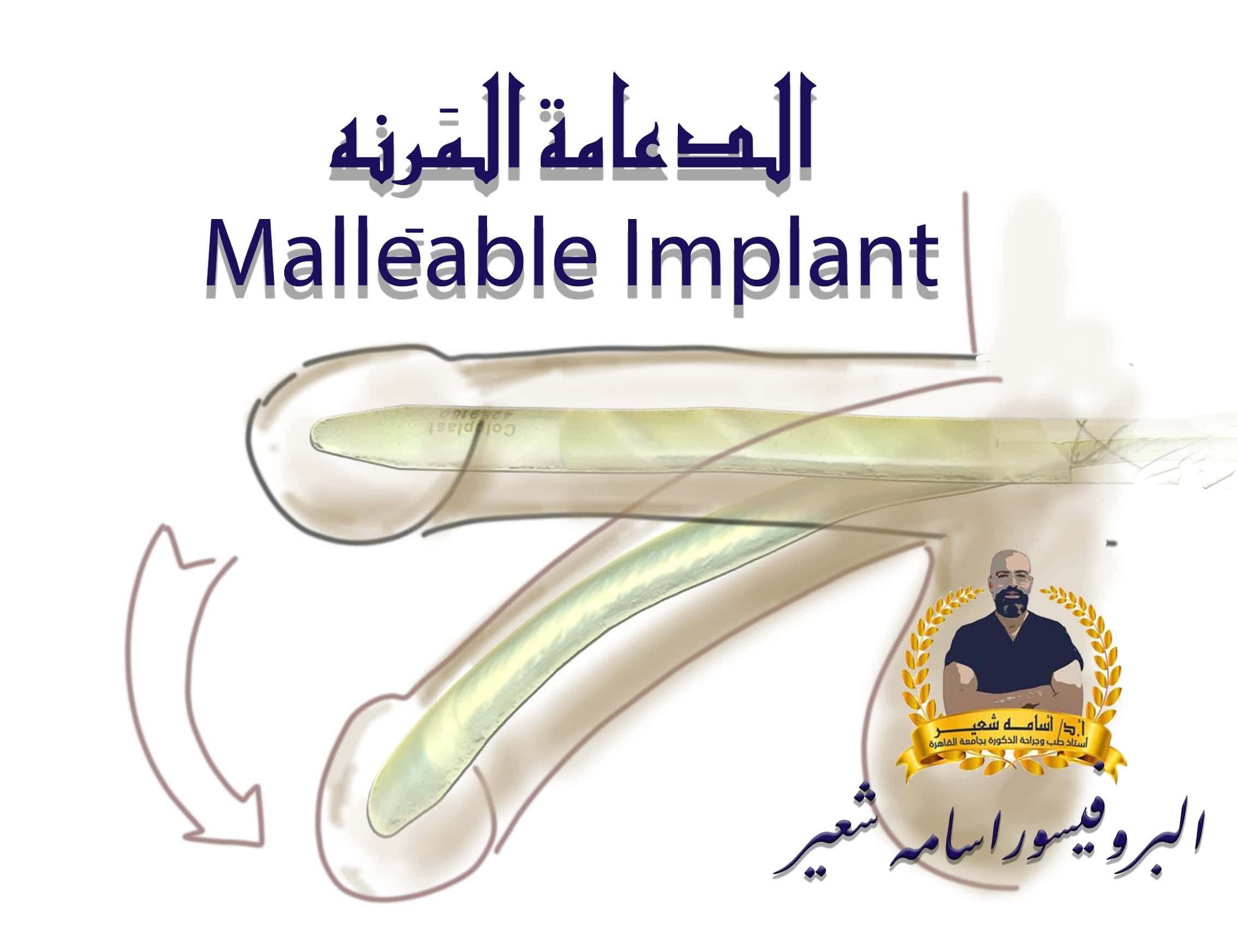 Malleable Penile Implant